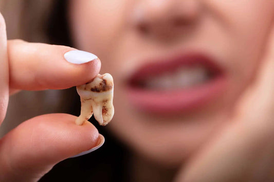 Caries : Comment les éviter grâce à une routine efficace ?